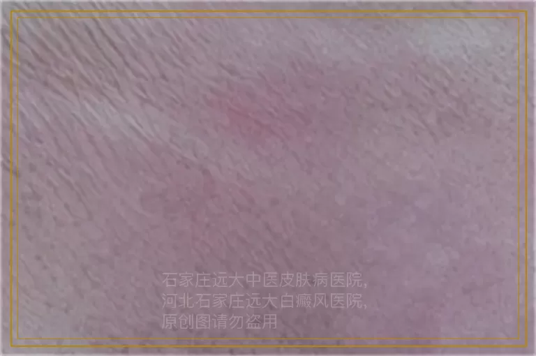 幼儿白癜风患者能吃药治疗吗