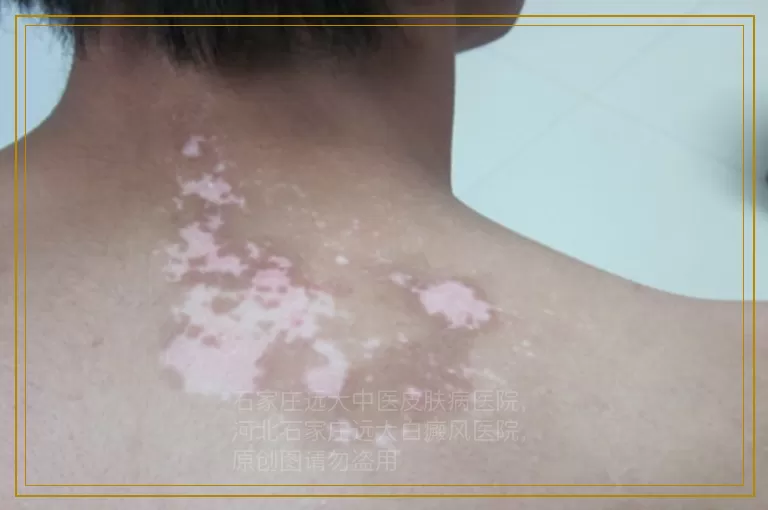 孩子脸上有一角钱大小的圆的白斑