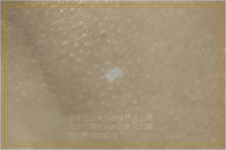 儿童白癜风擦药多久痊愈