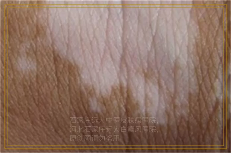 小孩头皮白癜风照308好吗