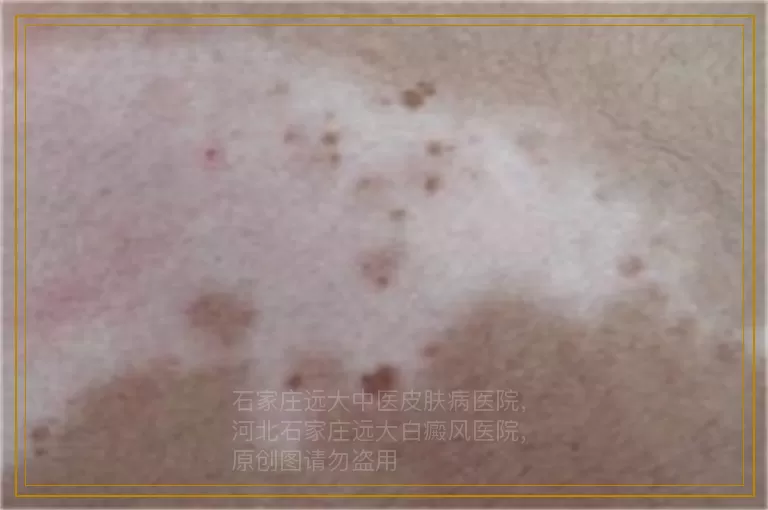 孩子胳膊上有白点是什么病
