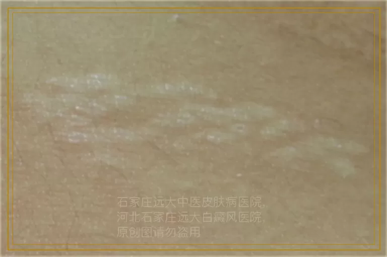 孩子嘴边皮肤有点发白两周了怎么回事