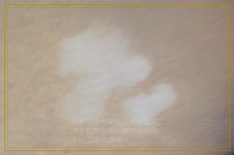 儿童肚皮一小块白斑照几次308能治好
