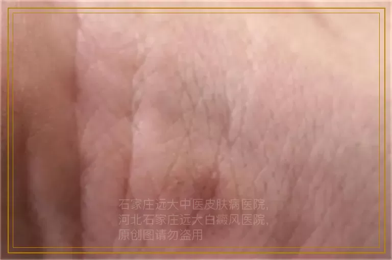 宝宝胳膊白斑的症状