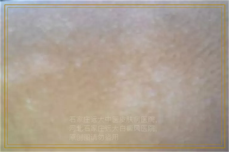 小儿白癜风有哪些症状怎么办