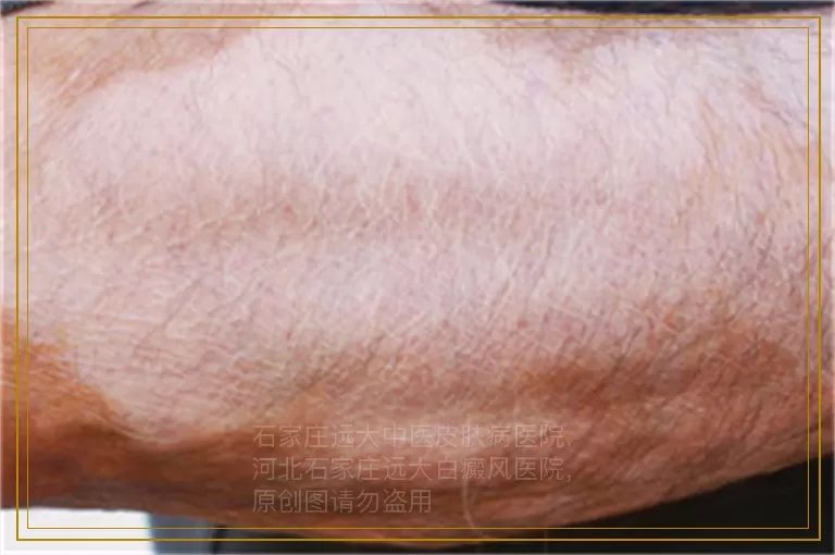 小孩大腿有白斑不痛不痒用什么药