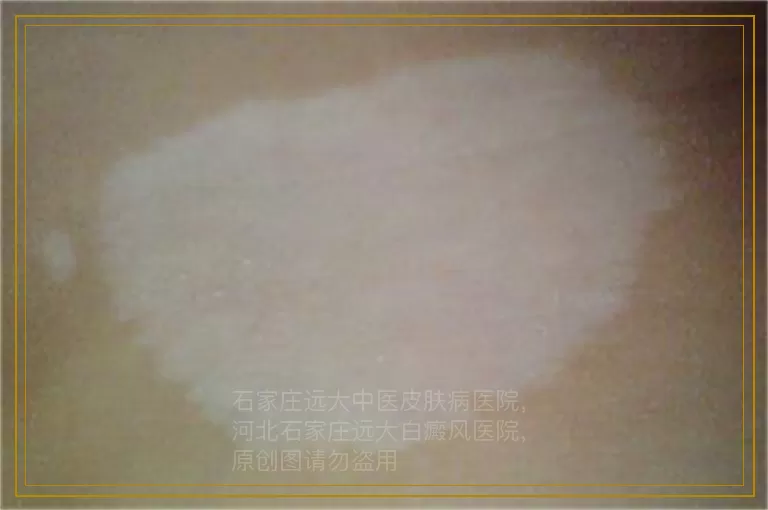 儿童后背有浅色白斑是白癜风吗