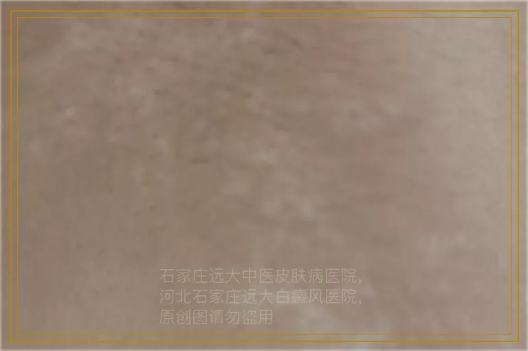 孩子身上白癜风白斑早期怎么治疗