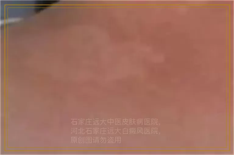 小孩子鬓角部位的白点会是白癜风吗