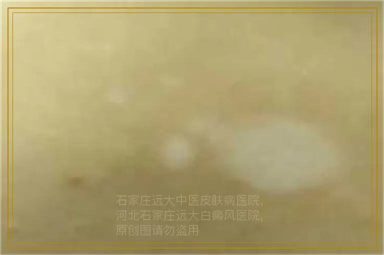 5岁孩子身上有光滑的白点点