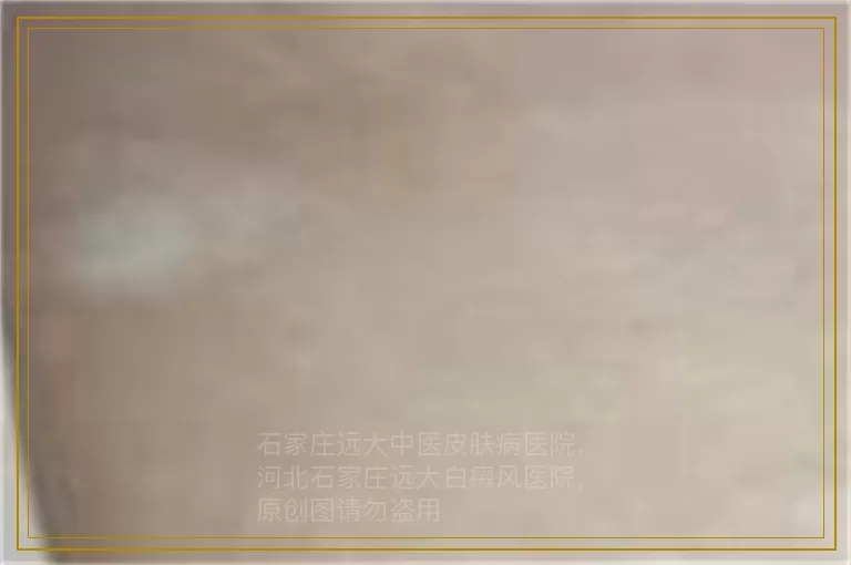 孩子的白癜风在左脸怎么治能好