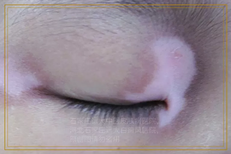 孩子白癜风怎么治好