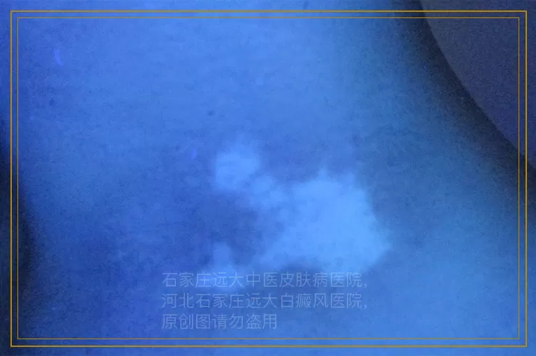 小孩白癜风怎么治安全效果还好