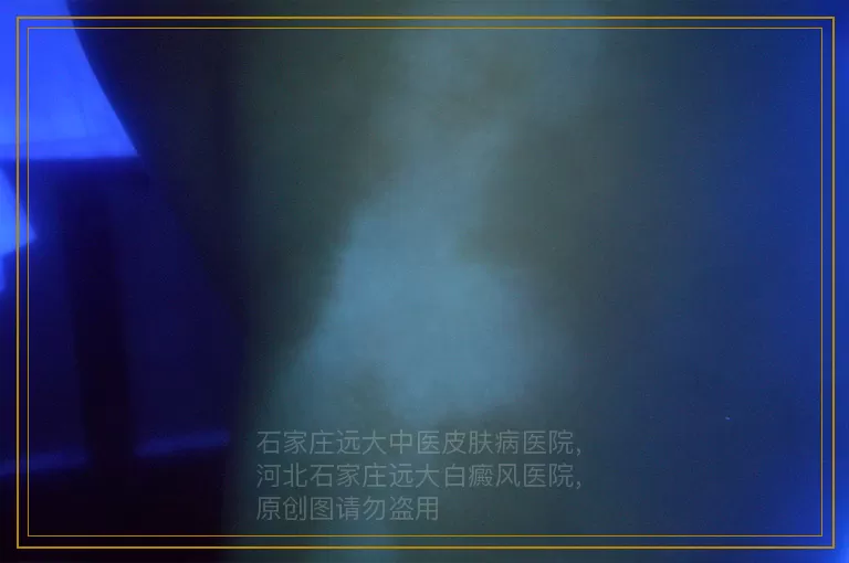 婴儿白癜风有什么症状