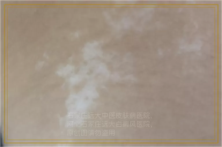 儿童额头白色斑点是不是白癜风