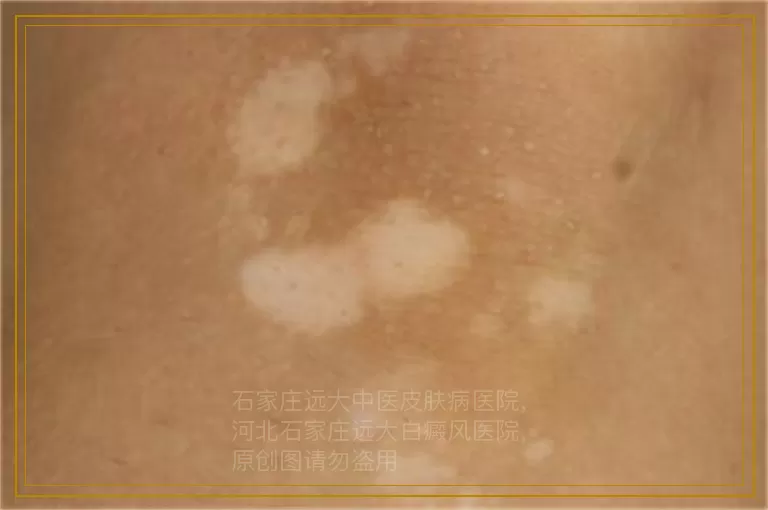 宝宝脸上初期白斑注意什么