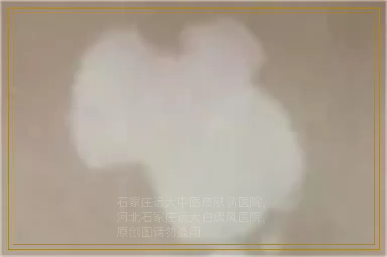 引发儿童白癜风的病因除了遗传还有啥?