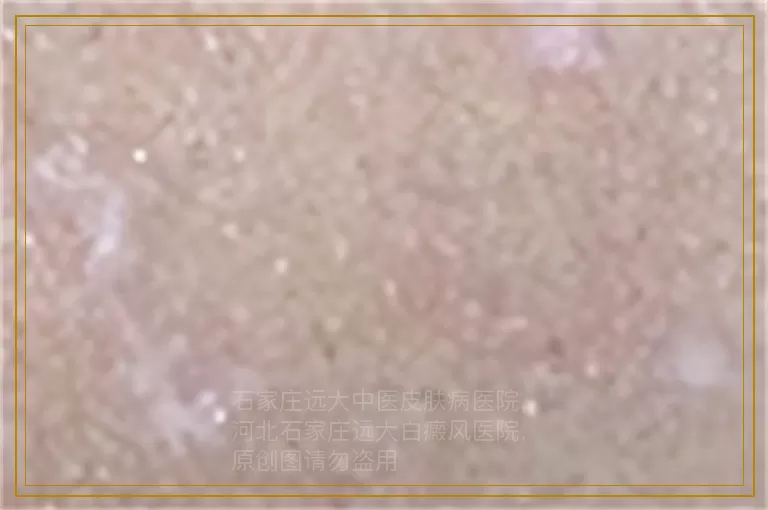 快速治疗小儿早期白癜风的方法