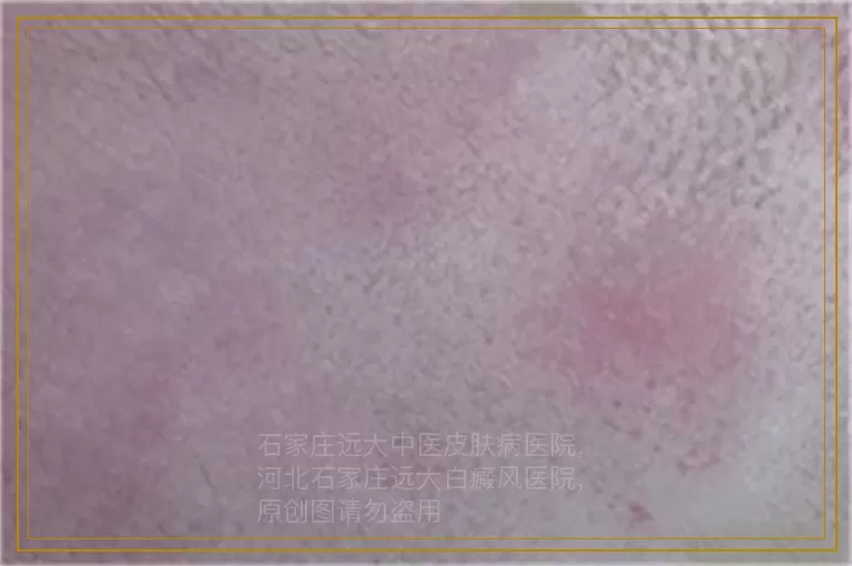 孩子早期长了白癜风怎么治疗