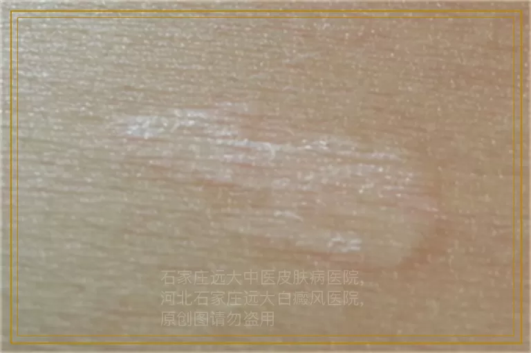 儿童白癜风照射308激光多久可以好
