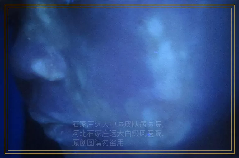 两岁宝宝得白癜风的几率有多大