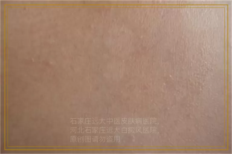 小孩膝盖上有白斑
