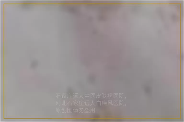儿童晕痣型白斑需要治疗多久