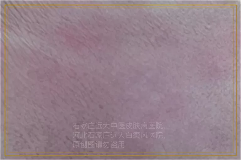 婴儿脖子褶皱处发白是怎么了
