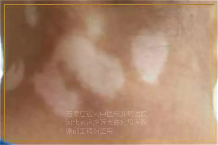 四岁宝宝嘴巴周围颜色发白