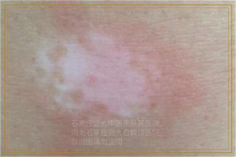 为孩子治疗白癜风需要注意什么