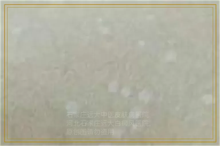 儿童照308治疗白癜风多久能好