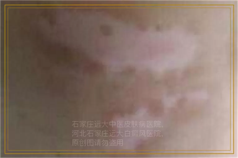 儿童面部出现白斑的原因有哪些