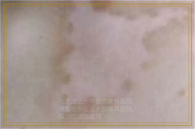 小孩子308治疗白癜风需要照几次