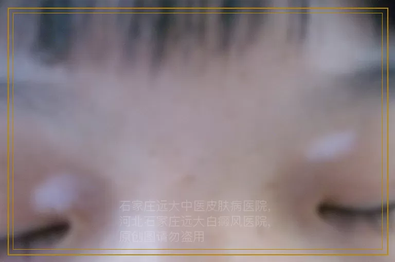 5岁孩子额头大片白癜风能不能照光