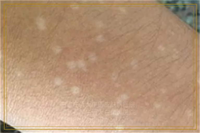 孩子前胸出现不规则的白色皮肤是什么
