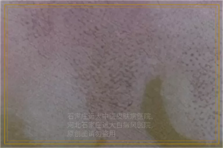 孩子身上起了好多白点是不是白癜风