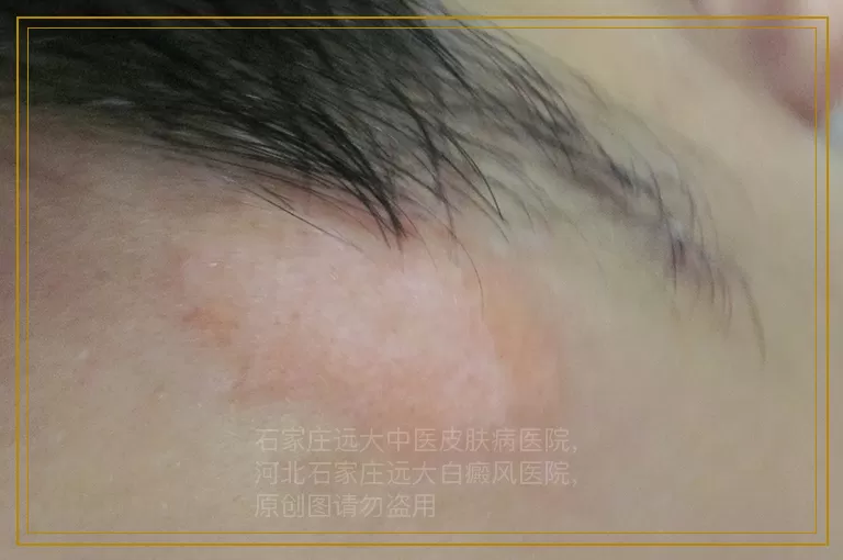 儿童得白癜风有效治疗偏方是什么