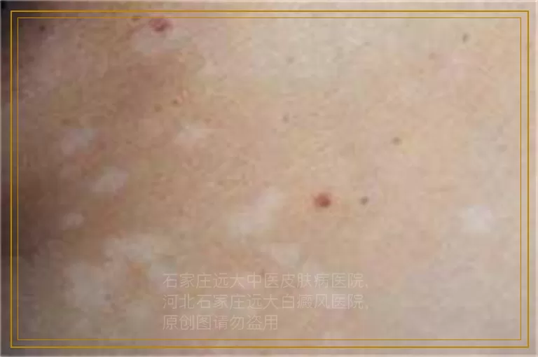 宝宝下巴出现白斑怎么治疗效果好