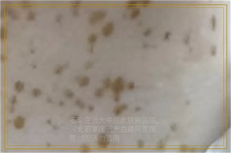 婴儿的皮肤上起了几块白斑是不是白癜风