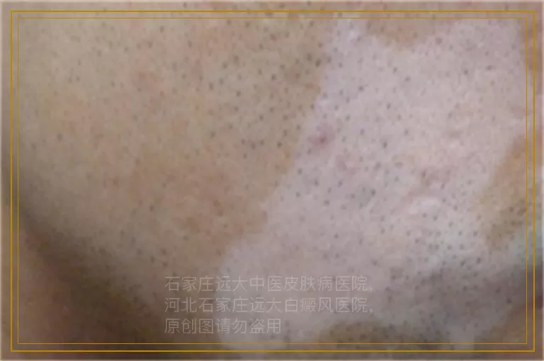 小儿白癜风的特征