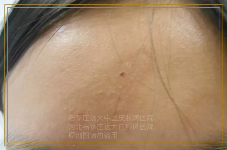 女性胸口淡白色的斑点比较小是什么