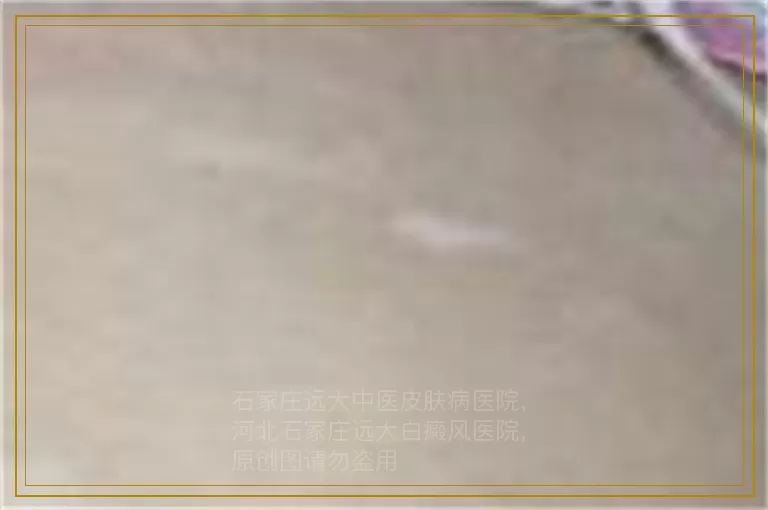 宝宝脸上有白癜风怎么办