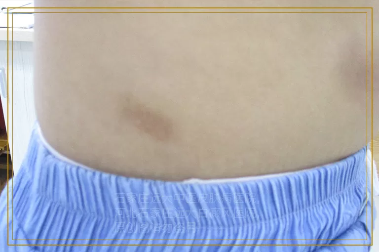 孩子刚出生身上有几块白斑是白癜风吗