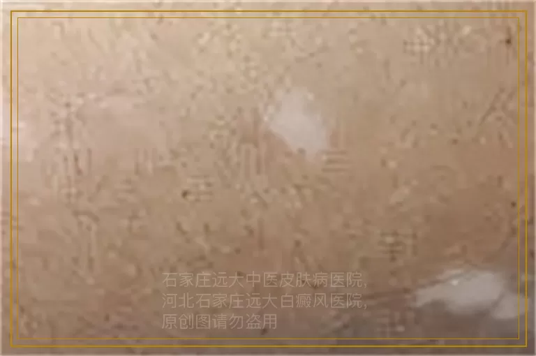 有小孩白癜风吃了管用的药吗