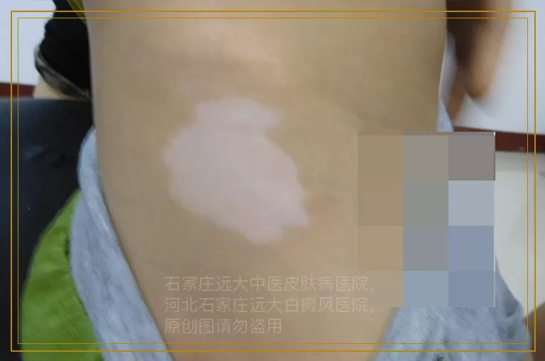 孩子脸上有白斑是什么原因导致的