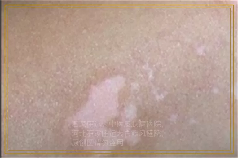 宝宝做308激光治好几率高吗