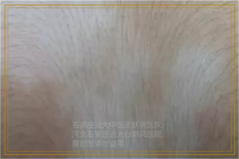 婴儿手腕上有一块白的皮肤怎么回事