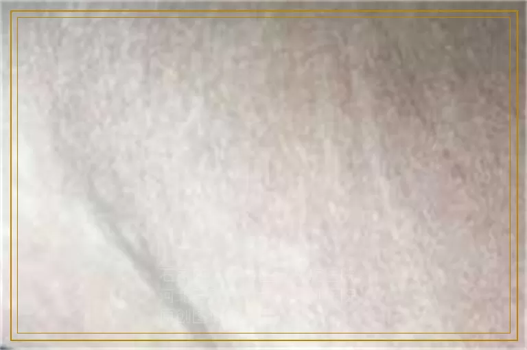 伍德灯照儿童白斑对身体有刺激吗