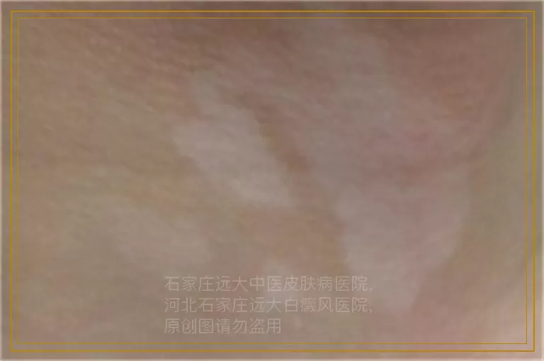 婴儿大腿内侧有一块白斑是什么