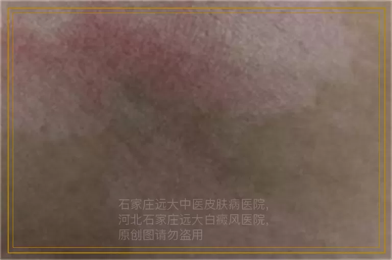 孩子脖子上长白点一个多月了怎么治
